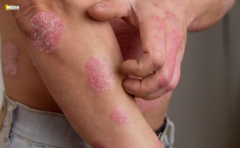 FDA aprova novo medicamento oral para psoríase moderada a grave