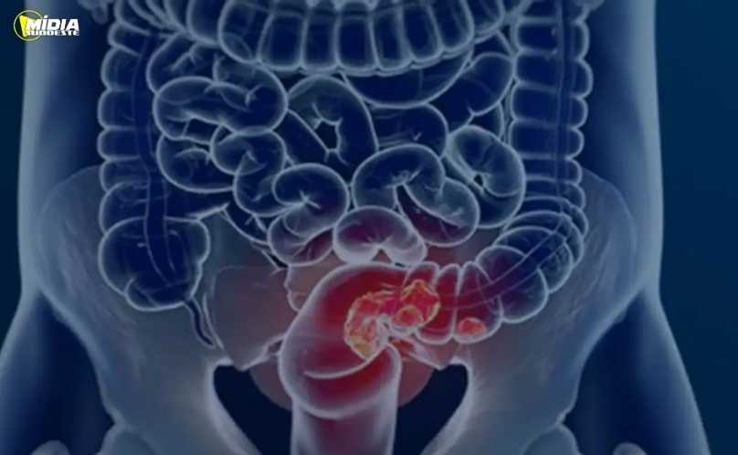 SUS adota novo exame para rastreamento do câncer de intestino
