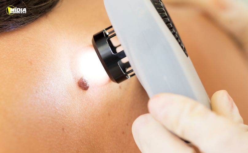 Diagnóstico precoce é decisivo contra o melanoma