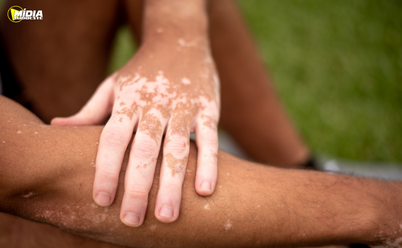 Hospital Dermatológico do Paraná amplia atendimento gratuito a pacientes com vitiligo
