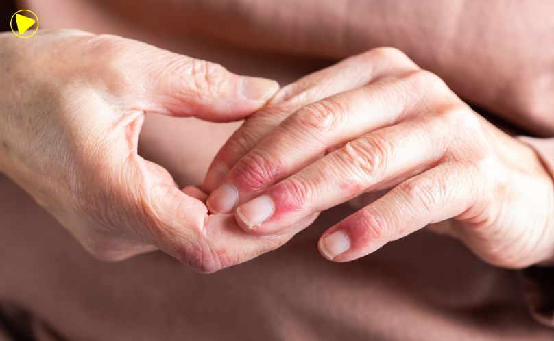 Dermatite atópica pode afetar pele, sono e autoestima