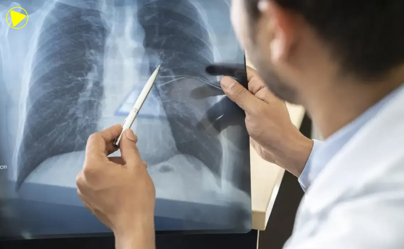 Anvisa aprova novo medicamento para tratamento de câncer de pulmão